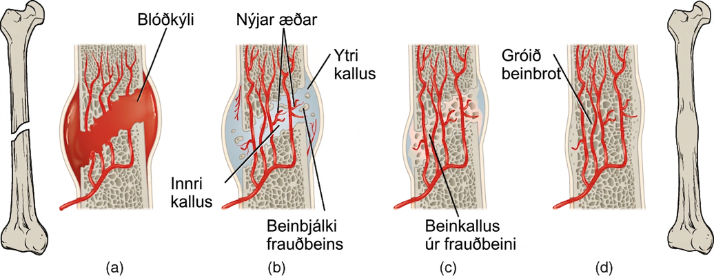 Myndin sýnir viðgerð beins í framvindu frá vinstri til hægri. Brotið sést lengst til vinstri, þar sem lokað skábrot liggur um mitt beinskaft lærleggsins. Næsta mynd stækkar brotstaðinn og sýnir að blóð hefur fyllt rýmið milli brotnu beinendanna. Blóð hefur einnig safnast beggja vegna brotsins. Blóðsöfnunin veldur bólgu á brotstaðnum og blóðkýli myndast. Á næstu mynd hefur ytri kallus komið í stað blóðkýlisins milli brotnu endanna. Innan innri kallussins hafa blóðæðar tengst á ný og nokkurt frauðbein endurmyndast í bilinu milli beinhlutanna tveggja. Á næstu mynd hefur frauðbein endurmyndast að fullu og tengir brotnu endana saman; það nefnist beinkallus. Ytri kallusinn er enn beggja vegna brotsins því þéttbein hefur ekki enn endurmyndast. Á lokamyndinni hefur þéttbeinið endurmyndast að fullu, umlykur beinkallusinn og tengir beinhlutana tvo alveg saman. Lítil bunga er á beininu þar sem brotið hefur gróið. Hún sést greinilega á síðustu, fjarlægari myndinni af fullgrónum lærleggnum.