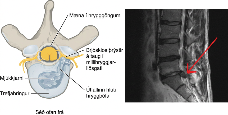 Myndin sýnir brjósklos. Vinstri myndhlutinn sýnir ofan frá hvernig hryggþófinn þrýstir á taug. Hægri myndhlutinn sýnir ljósmynd af brjósklosi.