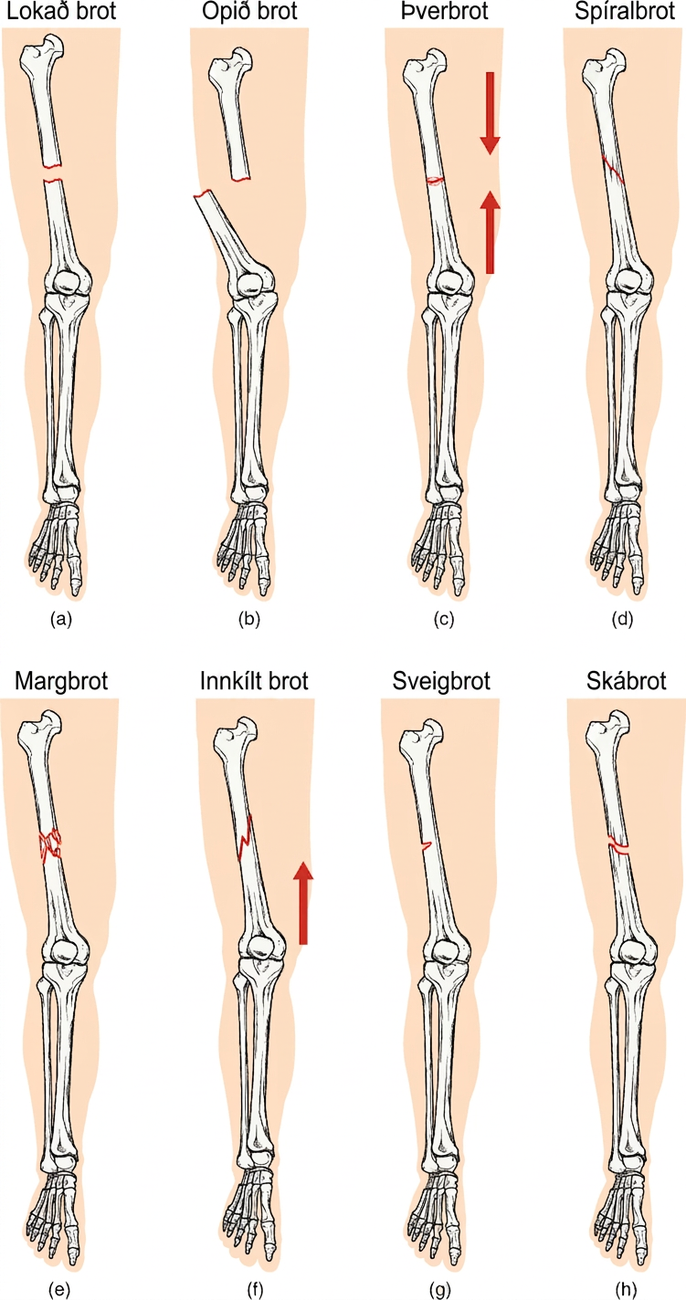 Á myndinni er hver gerð beinbrots sýnd á hægri lærlegg framan frá. Í lokaða brotinu er lærleggurinn brotinn um mitt beinskaftið og efri og neðri hluti beinsins alveg aðskildir. Brotflötunum ber þó enn saman. Í opna brotinu er lærleggurinn einnig brotinn um mitt beinskaftið og efri og neðri hlutinn alveg aðskildir. Ólíkt lokaða brotinu ber beinhlutunum ekki saman. Neðri hlutinn hefur snúist út til hliðar og skagar út í gegnum húð lærisins. Brotnu endarnir snúa ekki lengur hvor að öðrum. Við þverbrot liggur sprunga í gegnum alla breidd beinsins en brotnu endarnir hafa ekki skilist að. Brotlínan er hornrétt á lengdarás beinsins. Örvar sýna að slíkt brot stafar yfirleitt af þrýstingi á beinið í stefnu ofan frá og niður. Brotlína spíralbrots liggur skáhallt í gegnum beinið. Við margbrot liggja nokkrar samtengdar sprungur um miðju beinsins og beinið getur klofnað í marga litla hluta á brotstaðnum. Við innkílt brot sikksakkar brotlínan um breidd beinsins eins og elding. Ör sýnir að slík brot verða yfirleitt við högg sem þrýstir lærleggnum upp í líkamann. Sveigbrot er lítil sprunga sem nær ekki í gegnum alla breidd beinsins. Skábrotið á myndinni liggur skáhallt um beinskaft lærleggsins undir um þrjátíu gráðu horni.