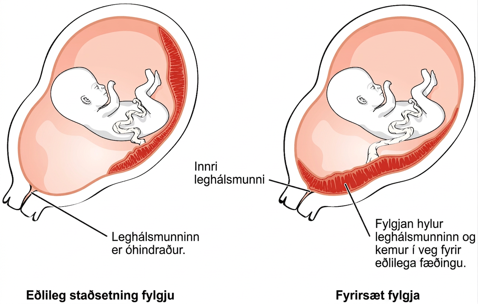 Vinstra megin sést fylgja ofarlega í legi en hægra megin fyrirsæt fylgja yfir innri leghálsmunna.