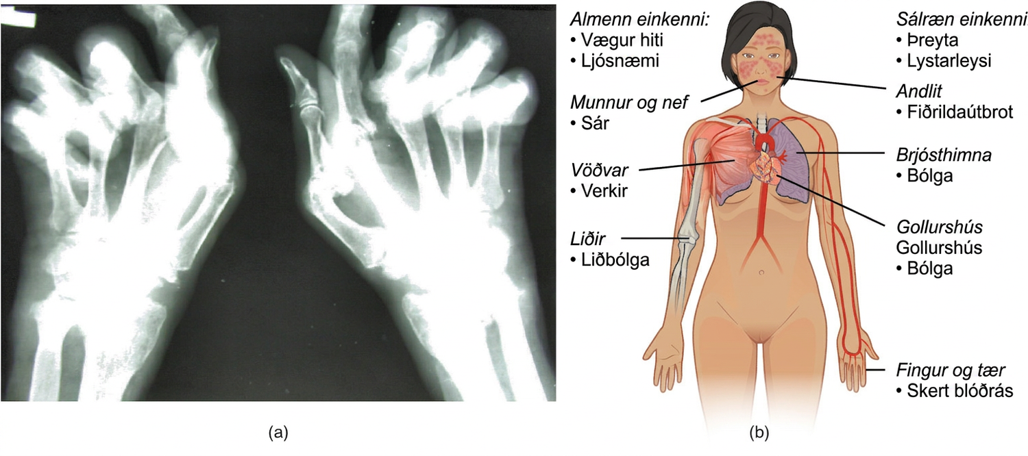 Vinstra megin er röntgenmynd af hendi einstaklings með iktsýki og hægra megin er líkamsskýringarmynd þar sem möguleg áhrif rauðra úlfa á húð, liði, nýru, hjarta, lungu, blóð og taugakerfi eru merkt.