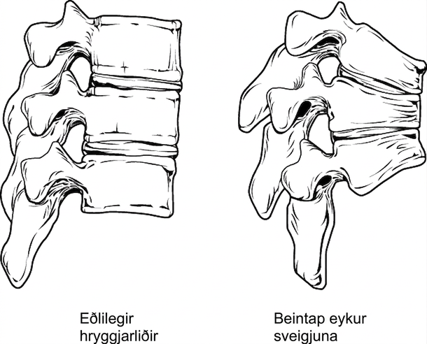 Myndin sýnir breytingar á hryggnum við beinþynningu. Vinstri myndhlutinn sýnir eðlilega hryggjarliði en sá hægri sýnir samfallna hryggjarliði og aukna sveigju.