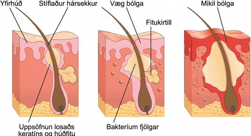 Þrjár skýringarmyndir sýna þróun unglingabóla í þremur skrefum frá vinstri til hægri. Allar sýna þær þverskurð af húð með hársekk. Á myndinni til vinstri er bólgið svæði um miðjan hárlegginn, rétt ofan við fitukirtil. Hársekkurinn er stíflaður af húðfitu sem er sýnd sem gulleitt efni. Á miðmyndinni hefur hársekkurinn bólgnað meira og merking sýnir að bakteríur fjölga sér í stíflunni. Húðþekjan í kring bólgnar vegna bakteríusýkingarinnar. Á myndinni lengst til hægri hefur stíflan bólgnað upp í um það bil fimmfalda upphafsstærð sína og rofið húðþekjuna í kring, sem er nú rauð og bólgin.