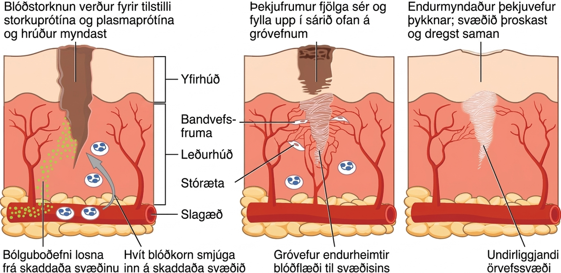 Skýringarmyndin sýnir græðslu sárs í þremur skrefum. Í hverju skrefi sést þverskurður af skaddaðri húð. Sárið nær í gegnum efra húðlagið, sem merkt er yfirhúð, og um það bil hálfa leið niður í leðurhúðina, dýpra neðra húðlagið. Neðst í þverskurðinum liggur slagæð lárétt um fituvef undir leðurhúðinni. Nokkrar litlar háræðar greinast frá slagæðinni og liggja upp í efri hluta leðurhúðarinnar. Í fyrsta skrefi græðslunnar losna boðefni bólgu, sýnd sem grænir punktar, frá skaðasvæðinu. Efnin berast um leðurhúðina og inn í láréttu slagæðina. Storkuprótín og plasmaprótín koma einnig storknun af stað í sárinu og mynda hrúður. Í öðru skrefi sést hrúðrið greinilega sem svartur og brúnn massi yfir efri hluta sársins. Undir hrúðrinu fjölga þekjufrumur yfirhúðarinnar sér og byrja að fylla sárið. Í leðurhúðinni binda þrjár trefjafrumur sársvæðið saman með hvítum vef. Þessi vefur er gróvefur. Myndun gróvefs endurheimtir blóðflæði, eins og háræðarnar sem vaxa umhverfis sársvæðið sýna. Í þriðja skrefi er hrúðrið horfið og yfirhúðin hefur vaxið saman og dregist saman svo efri hluti sársins lokast. Dýpra í húðinni hefur gróvefur fyllt sárið að fullu og telst nú örvefur.