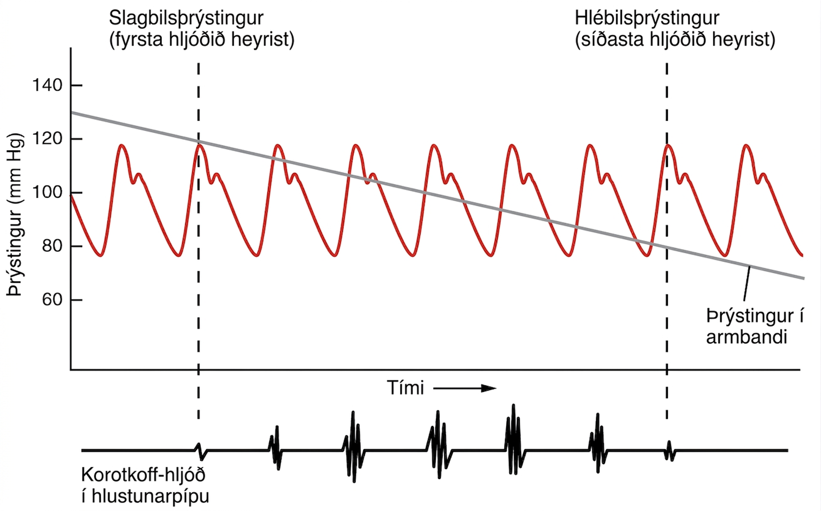 Línurit sem sýnir slagæðaþrýsting yfir tíma og merkir fyrsta og síðasta Korotkoff-hljóðið við slagbils- og hlébilsþrýsting.