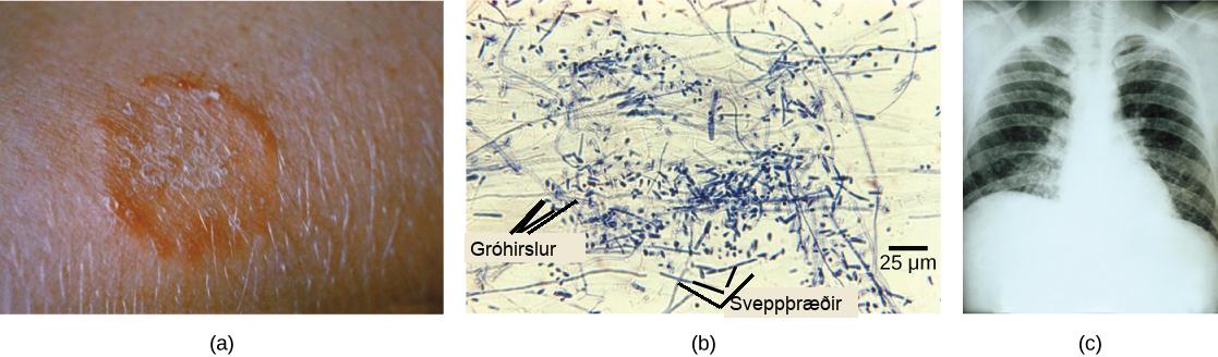 Part A is a photo of a red, ring-shaped skin lesion. Part B is a micrograph of long, thread-like mycelia and small, oval sporangia. Part C is a chest X-ray of a person with a fungal infection.