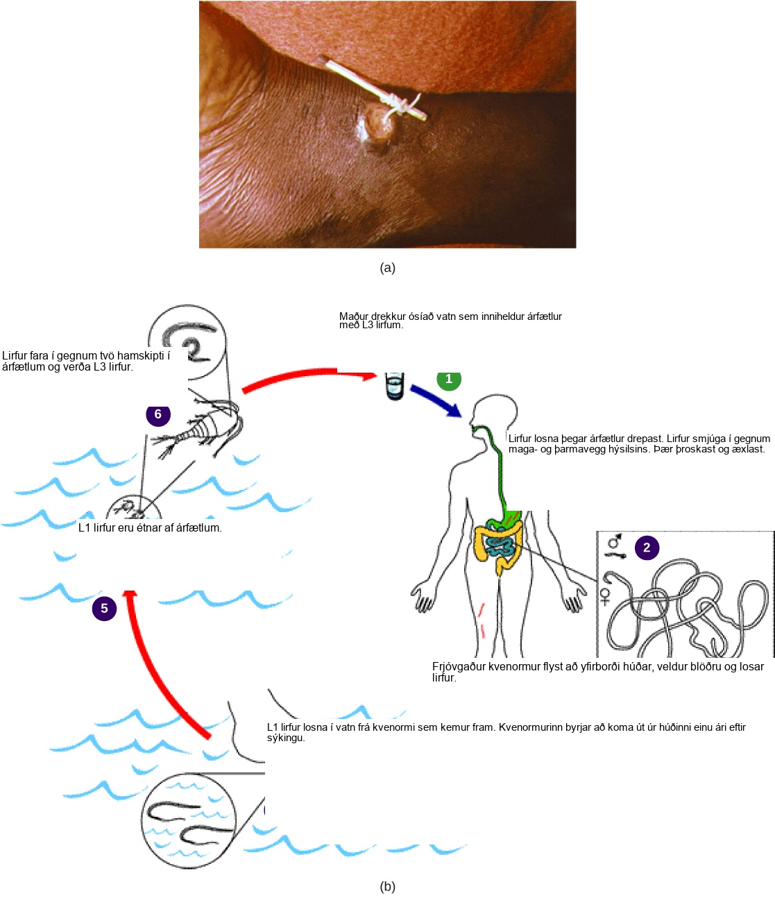 Part A shows a foot with a guinea worm extending from a blister. The end of the worm is wrapped around a stick. Part B shows the life cycle of the guinea worm, which begins when a person drinks unfiltered water containing copepods infected with guinea worm larvae. Larvae, which are released when the copepods die, penetrate the wall of the stomach and intestine. The worms mature and reproduce. Fertilized females migrate to the surface of the skin, where they discharge larvae into the water. Copepods consume the larvae. The copepods are consumed by humans, completing the cycle. About a year after infection, the female worm emerges from the skin.