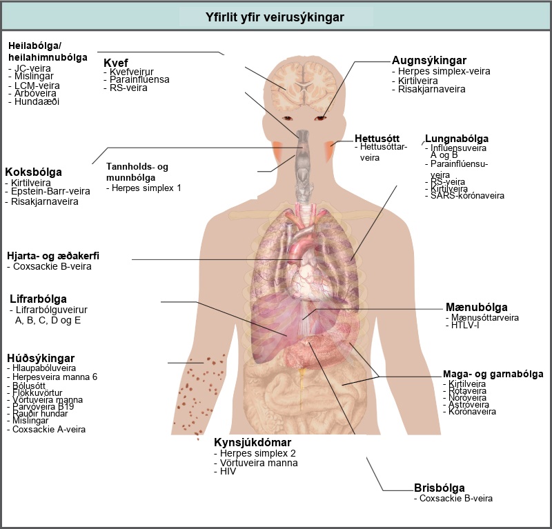 The illustration shows an overview of human viral diseases. Viruses that cause encephalitis or meningitis, or inflammation of the brain and surrounding tissues, include measles, arbovirus, rabies, J C virus, and L C M virus. The common cold is caused by rhinovirus, parainfluenza virus, and respiratory syncytial virus. Eye infections are caused by herpes simple virus, adenovirus, and cytomegalovirus. Pharyngitis, or inflammation of the pharynx, is caused by adenovirus, Epstein-Barr virus, and cytomegalovirus. Parotitis, or inflammation of the parotid glands, is caused by mumps virus. Gingivostomatitis, or inflammation of the oral mucosa, is caused by herpes simplex type I virus. Pneumonia is caused by influenza virus types A and B, parainfluenza virus, respiratory syncytial virus, adenovirus, and SARS coronavirus. Cardiovascular problems are caused by coxsackie B virus. Hepatitis is caused by hepatitis virus types A, B, C, D, and E. Myelitis in the spinal cord is caused by poliovirus and H L T V dash 1. Skin infections are caused by varicella-zoster virus, human herpesvirus 6, smallpox, molluscum contagiosum, human papillomavirus, parvovirus B 19, rubella, measles, and coxsackie A virus. Gastroenteritis, or digestive disease, is caused by adenovirus, rotavirus, norovirus, astrovirus, and coronavirus. Sexually transmitted diseases are caused by herpes simplex type 2, human papillomavirus, and H I V. Pancreatitis is caused by coxsackie B virus.