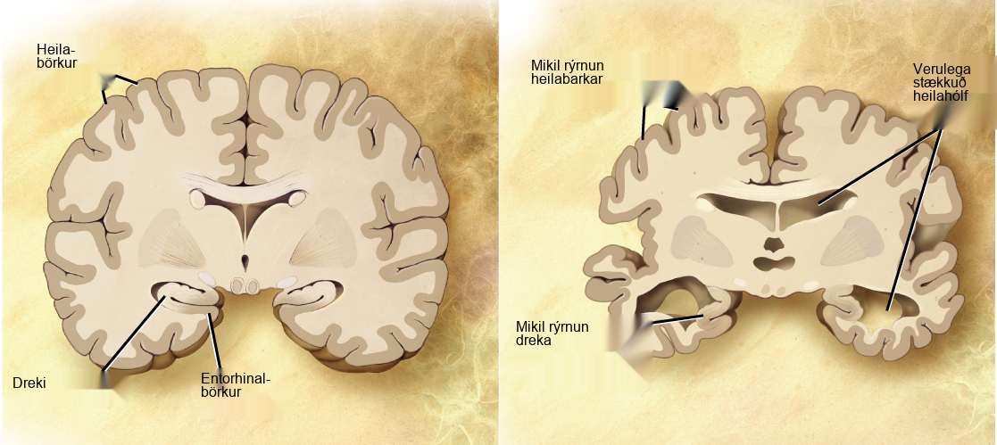A cross section of a normal brain and the brain of an Alzheimers patient are compared. In the Alzheimers brain, the cerebral cortex is greatly shrunken in size as is the hippocampus. Ventricles, holes in the center and bottom right and left parts of the brain, are also enlarged.