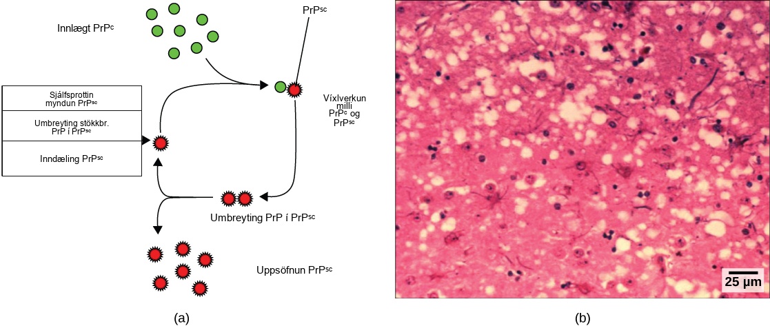 Part A illustrates how normal prion protein, called P r P, is converted into the disease causing form P r P. P r P superscript lowercase s lowercase c may spontaneously form in brain tissue, may be introduced when a mutant form of the protein misfolds, or may introduced into the brain tissue by inoculation. The misfolded protein causes normal P r P already present in the brain to misfold. A chain reaction occurs, leading to a large amount of misfolded protein. Part B is a light microscopy image of prion-infected brain tissue.