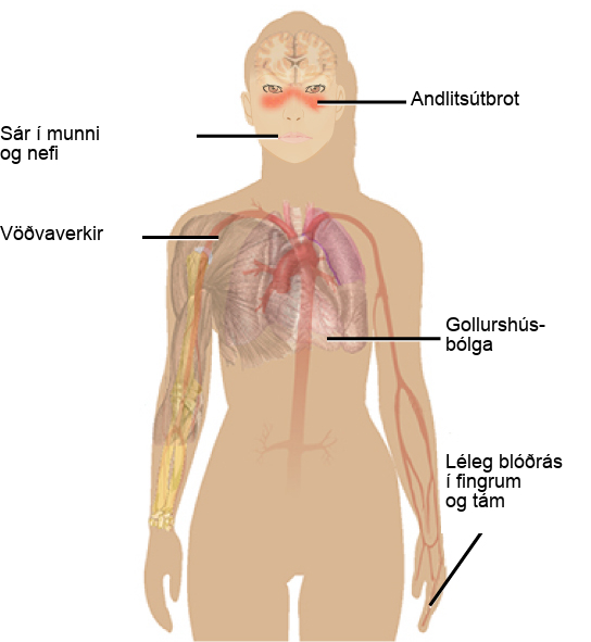 Illustration shows the symptoms of lupus, which include a face rash, ulcers in the mouth and nose, muscle aches, inflammation of the pericardium and poor circulation in the fingers and toes.