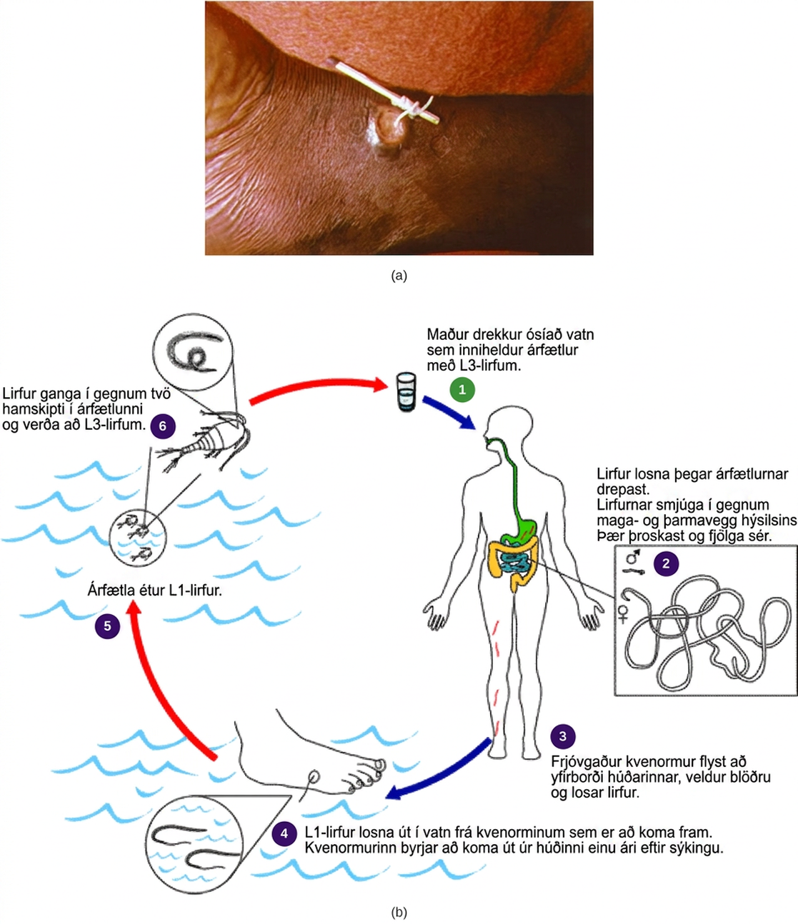 Part A shows a foot with a guinea worm extending from a blister. The end of the worm is wrapped around a stick. Part B shows the life cycle of the guinea worm, which begins when a person drinks unfiltered water containing copepods infected with guinea worm larvae. Larvae, which are released when the copepods die, penetrate the wall of the stomach and intestine. The worms mature and reproduce. Fertilized females migrate to the surface of the skin, where they discharge larvae into the water. Copepods consume the larvae. The copepods are consumed by humans, completing the cycle. About a year after infection, the female worm emerges from the skin.
