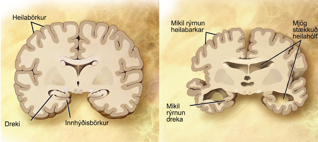 A cross section of a normal brain and the brain of an Alzheimers patient are compared. In the Alzheimers brain, the cerebral cortex is greatly shrunken in size as is the hippocampus. Ventricles, holes in the center and bottom right and left parts of the brain, are also enlarged.