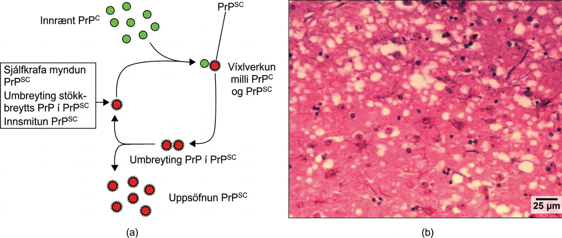 Part A illustrates how normal prion protein, called P r P, is converted into the disease causing form P r P. P r P superscript lowercase s lowercase c may spontaneously form in brain tissue, may be introduced when a mutant form of the protein misfolds, or may introduced into the brain tissue by inoculation. The misfolded protein causes normal P r P already present in the brain to misfold. A chain reaction occurs, leading to a large amount of misfolded protein. Part B is a light microscopy image of prion-infected brain tissue.