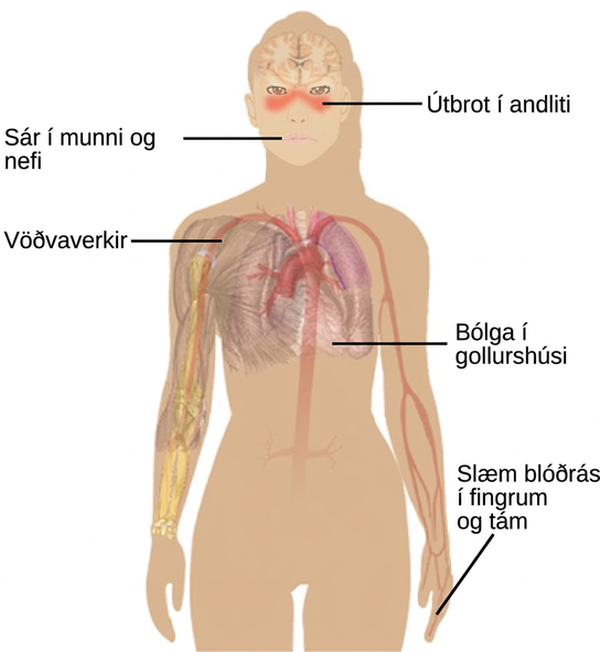 Illustration shows the symptoms of lupus, which include a face rash, ulcers in the mouth and nose, muscle aches, inflammation of the pericardium and poor circulation in the fingers and toes.