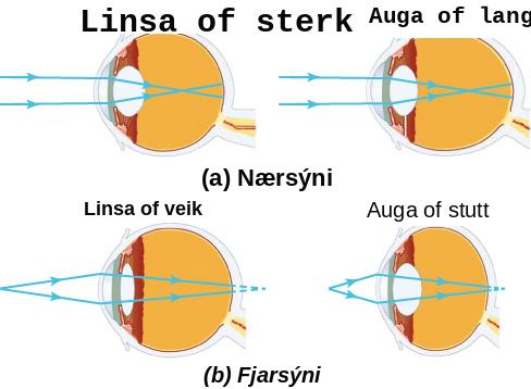Tvö augnþversnið bera saman nærsýni og fjarsýni; í nærsýni myndast fókus fyrir framan sjónhimnu og í fjarsýni myndast fókus fyrir aftan hana.