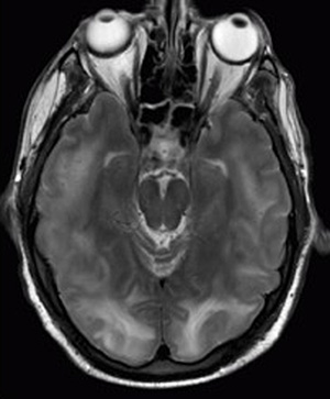 An MRI image of a brain is shown. This type of photography uses electromagnetic radiation to produce images.