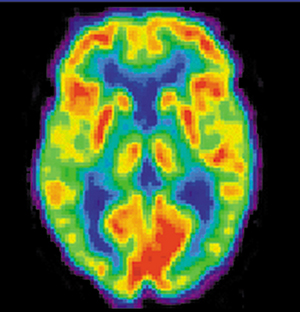 Heilamynd af sjúklingi með Alzheimer-sjúkdóm sem var gerð með geislavirku lyfi.