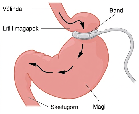 Skýringarmynd sýnir magaband vafið um efri hluta magans. Fyrir ofan bandið er lítill magapoki merktur og fyrir neðan magann er skeifugörn merkt. Örvar sýna leið meltrar fæðu frá vélinda niður í gegnum maga og áfram í skeifugörn.