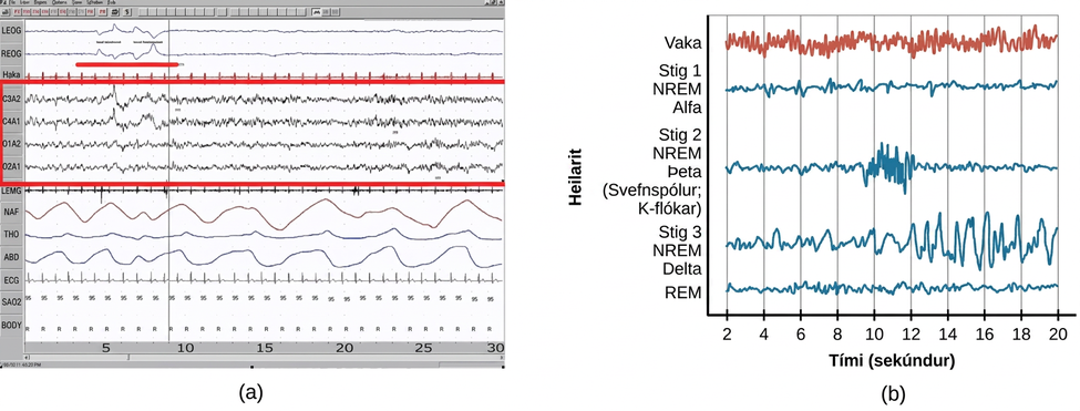 Chart A is a polysonograph with the period of rapid eye movement (REM) highlighted. Chart b shows brainwaves at various stages of sleep, with the “awake” stage highlighted to show its similarity to the wave pattern of “REM” in chart A.