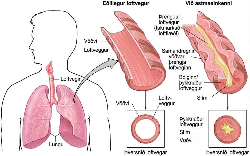 The effect of asthma on airways is illustrated. A silhouette of a person is shown with the lungs and airways labeled. There is an arrow coming from an airway in the lung leading to a magnification of a normal airway. A cross-section of the normal airway shows the muscle and the airway wall, with plenty of room for air to get through. An airway during asthma symptoms is also shown, and the labeled symptoms are narrowed airway (limited air flow), tightened muscles constrict airway, inflamed/thickened airway wall, and mucus. A cross-section of the airway during asthma symptoms shows the thickened airway wall, mucus and muscle. There is much less room for air to get through.